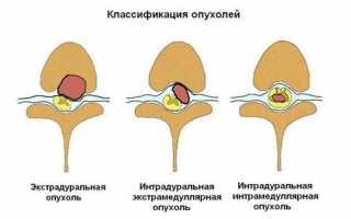 Рак позвоночника: что нужно знать